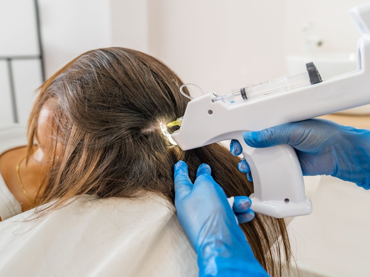 Mesoterapia incluida a 6 meses