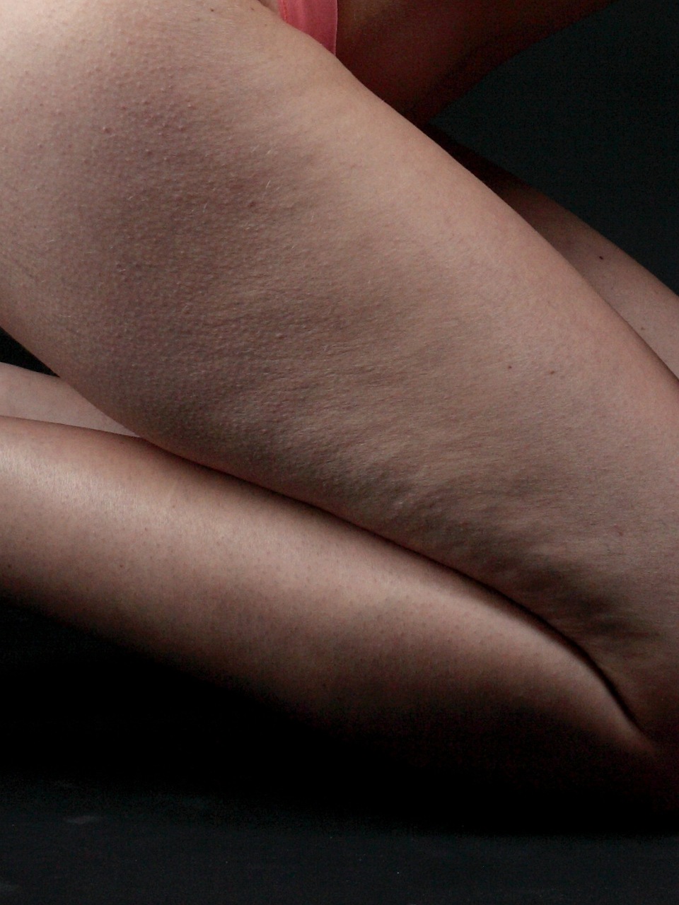 Tratamiento médico de la celulitis en Clínicas No Filters