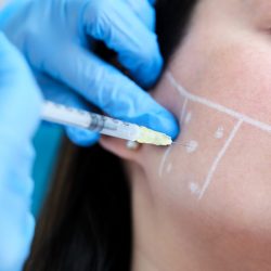 facial marking with white dermoplastic pencil of points for mandibular anti-bruxism treatment with botulinum toxin