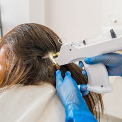 An Application of capillary mesotherapy treatment to help with hair loss